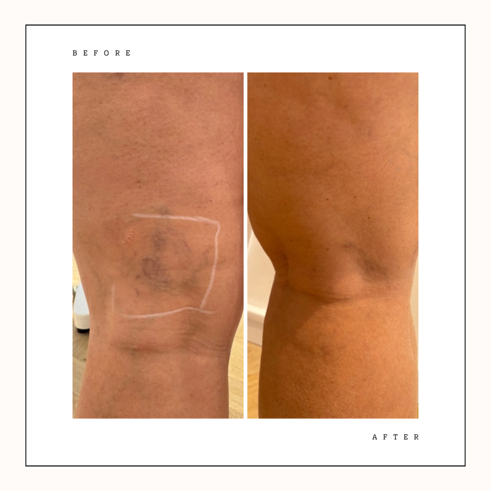 Before and after leg vein removal treatment