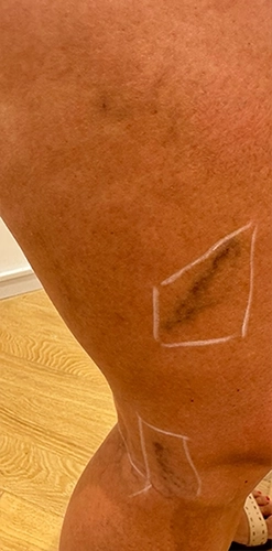 Before treatment - leg veins
