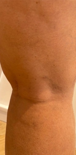 After treatment - cleared spider veins