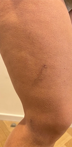 After treatment - cleared leg veins
