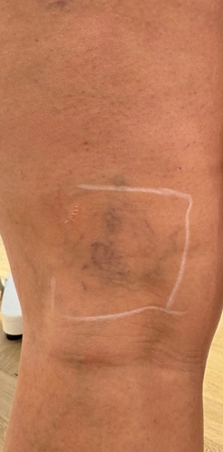 Before treatment - spider veins