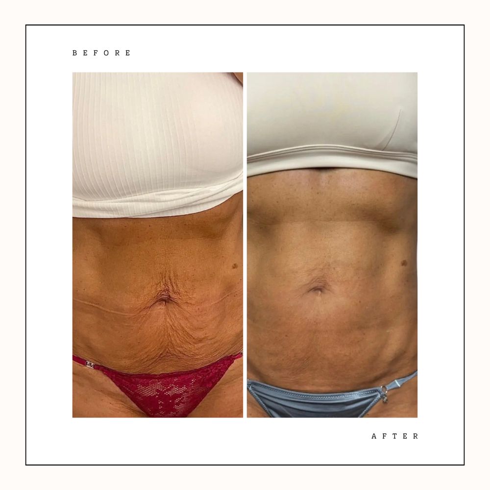 Before and after stomach tightening