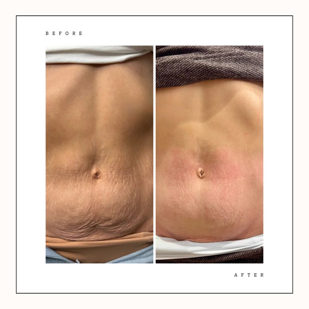 Before and after stomach tightening