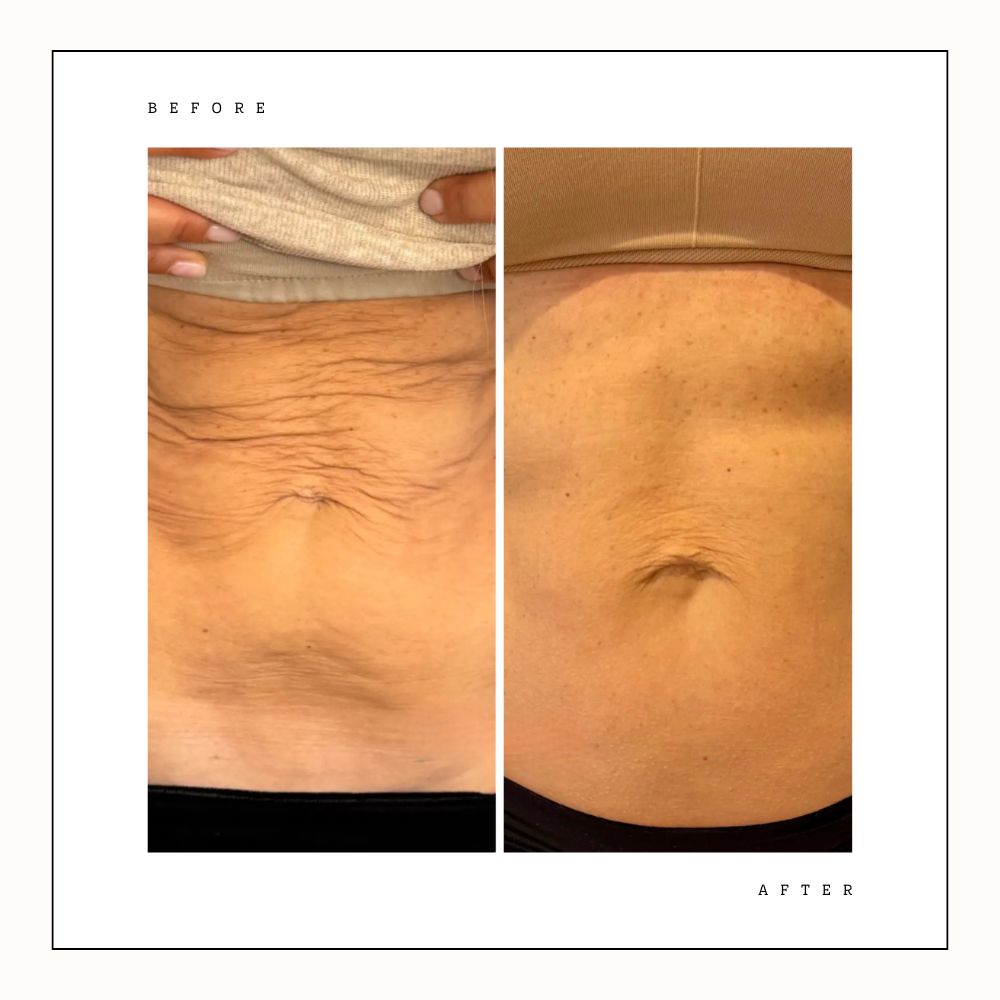 Before and after stomach tightening