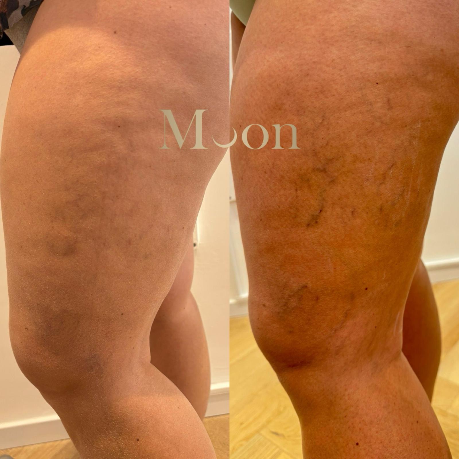 Before treatment