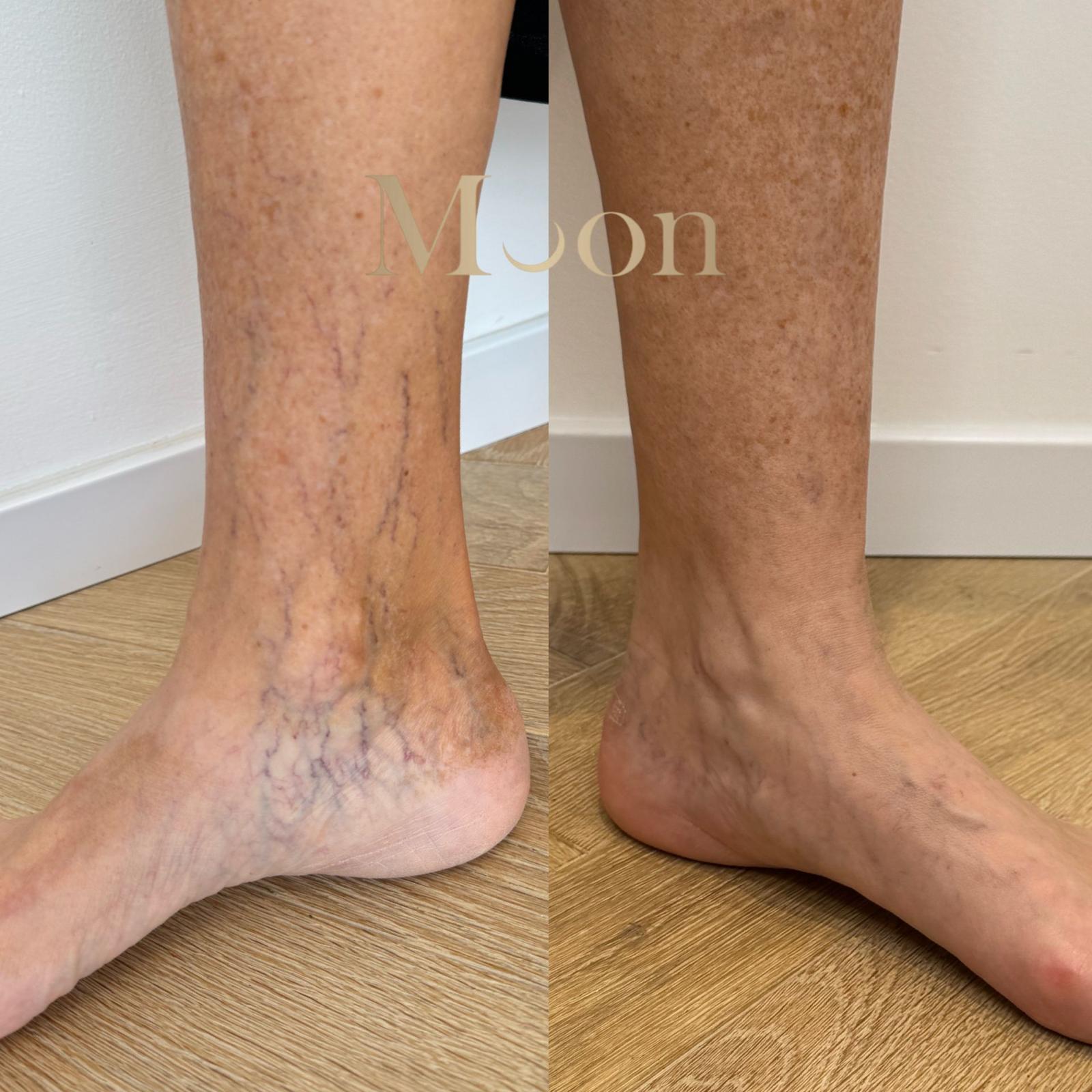 Before and after leg vein removal treatment